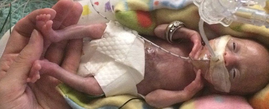 worlds-most-premature-baby-21-weeks_1024
