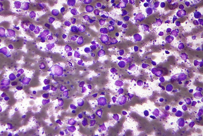1200px-diffuse_large_b_cell_lymphoma_-_cytology_low_mag