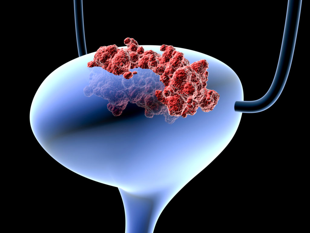 bladdercancer