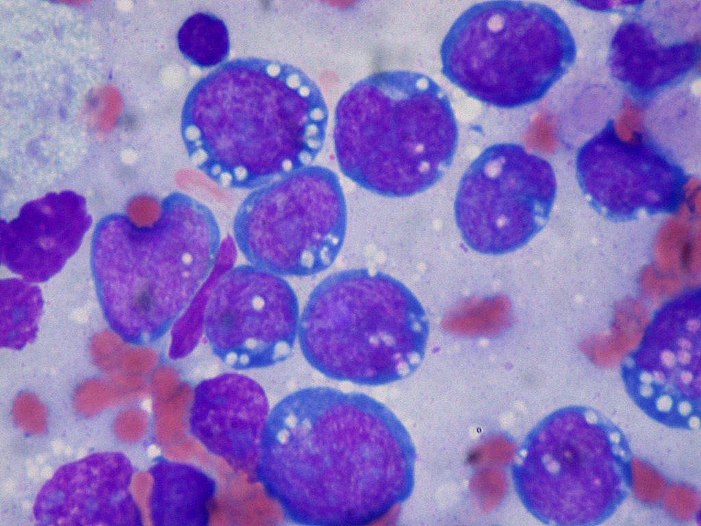 burkitt_lymphoma_touch_prep_wright_stain
