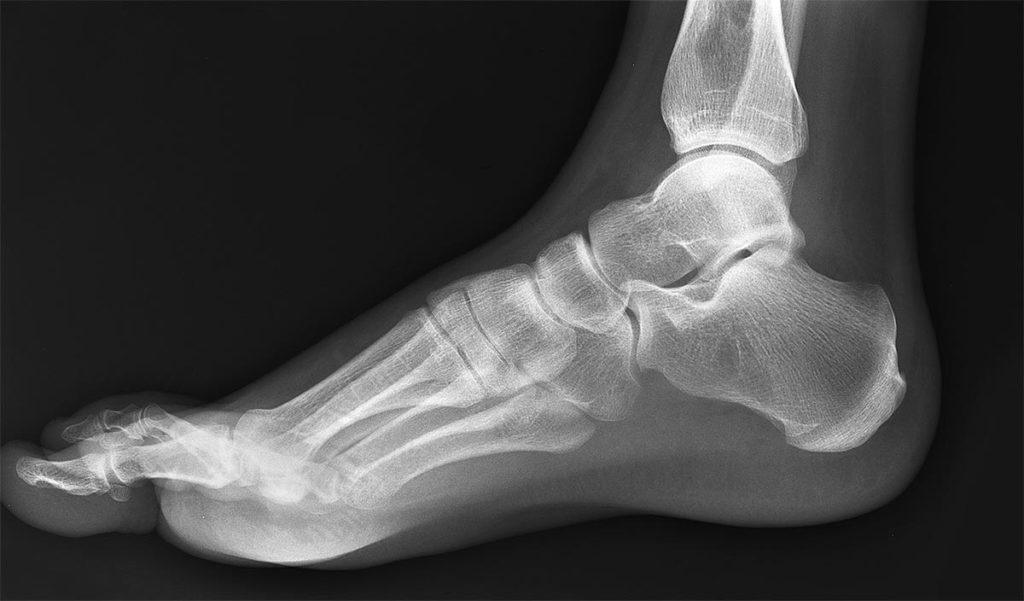 foot-xray