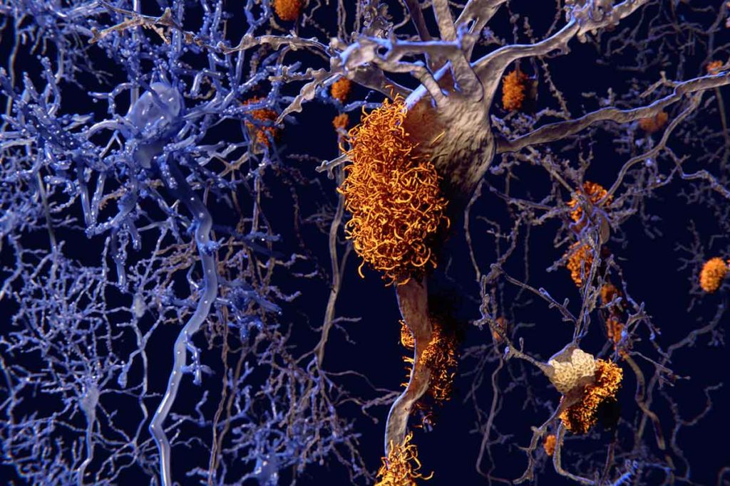 f0117797-brain_nerve_cells_affected_by_alzheimers-spl