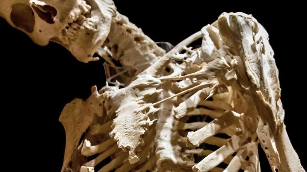 sn-fibrodysplasia