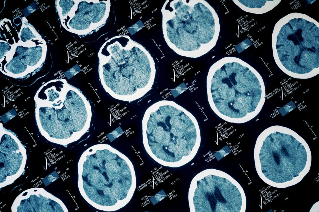 brain-scans-124775671