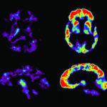 Аспирин защитил мозг мышей от проявлений болезни Альцгеймера