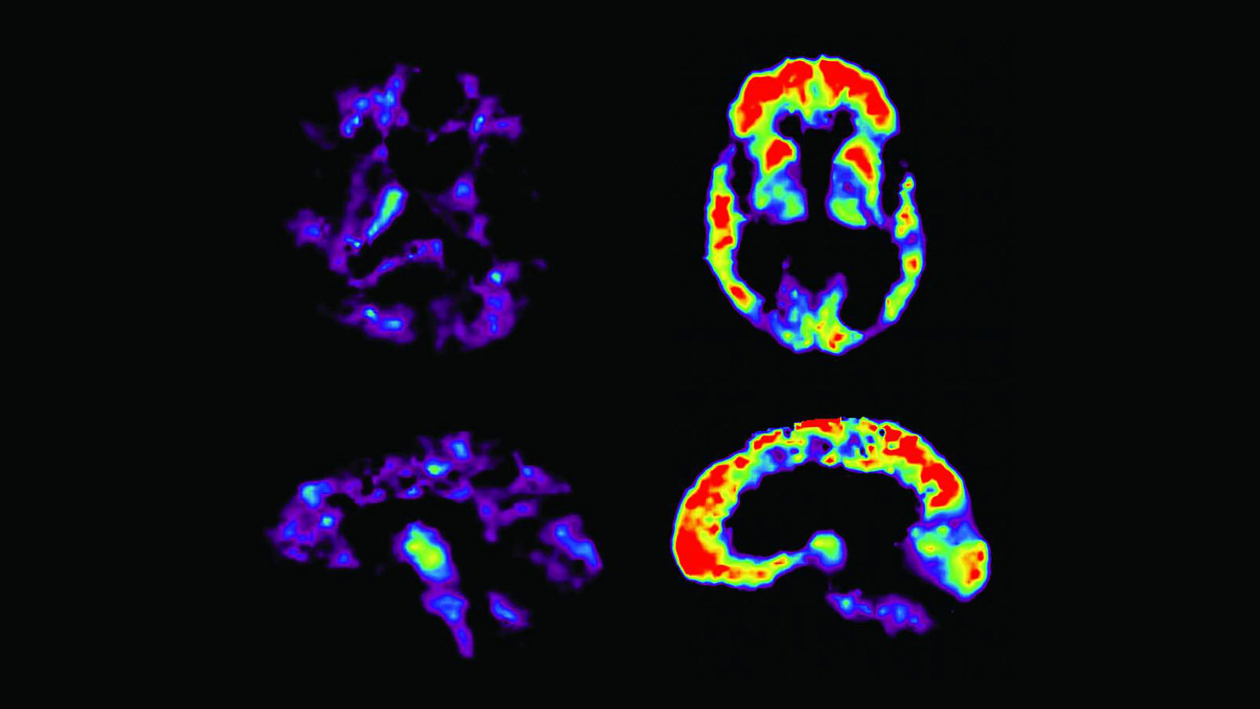 alzheimers-brain-scan