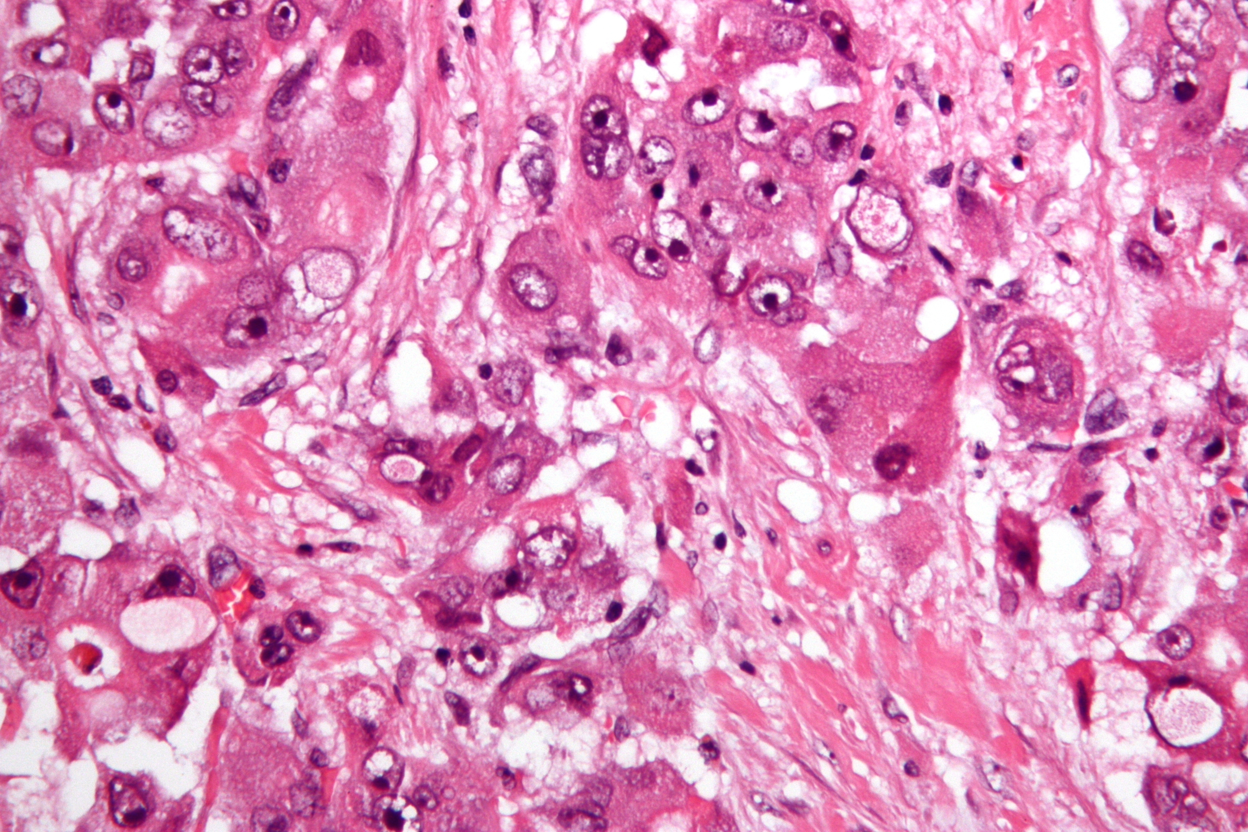 fibrolamellar_hepatocellular_carcinoma_-2-_very_high_mag