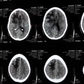 space-occupying-lesion-with-midline-shift-sol-with-mass-effect-space-occupying-lesion-with-midline-shift-sol-with-mass-effect-braintumors-ct-scan