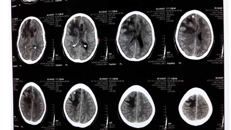 space-occupying-lesion-with-midline-shift-sol-with-mass-effect-space-occupying-lesion-with-midline-shift-sol-with-mass-effect-braintumors-ct-scan