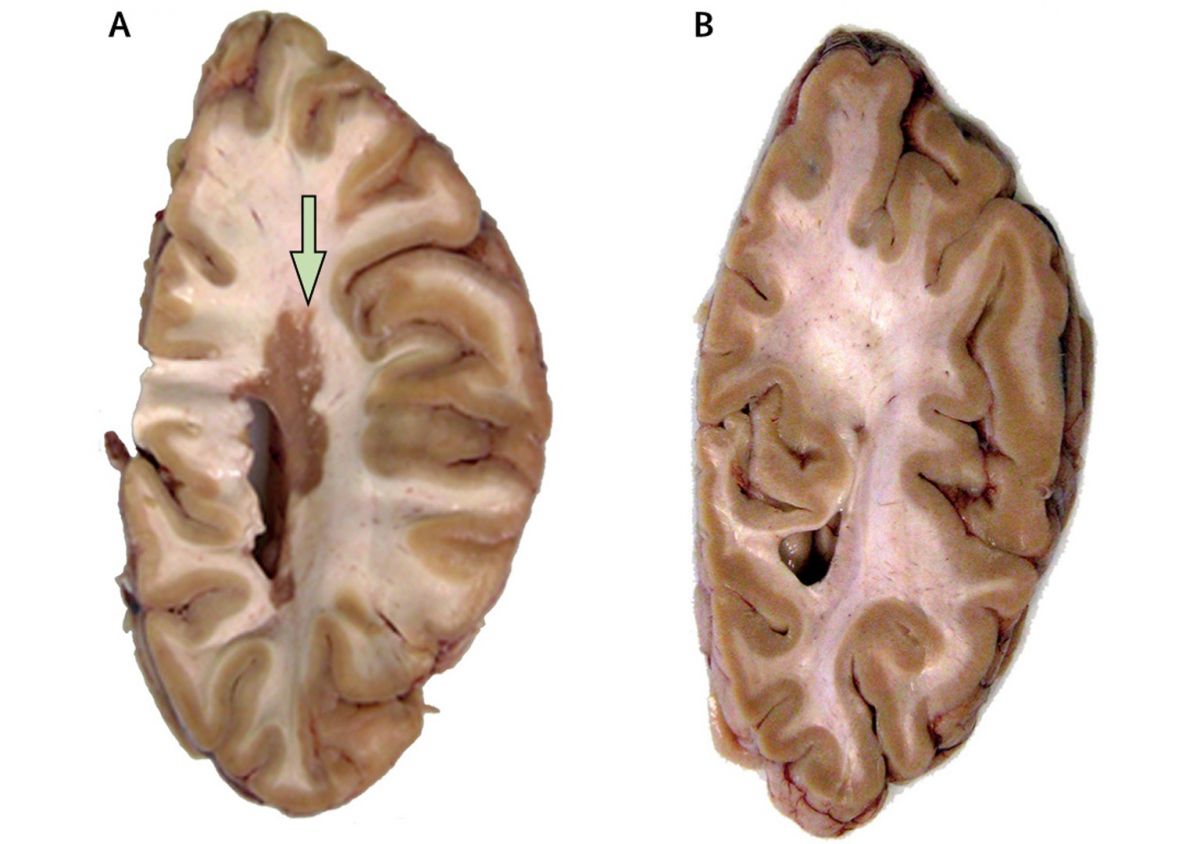 Стоковые фотографии по запросу Multiple sclerosis