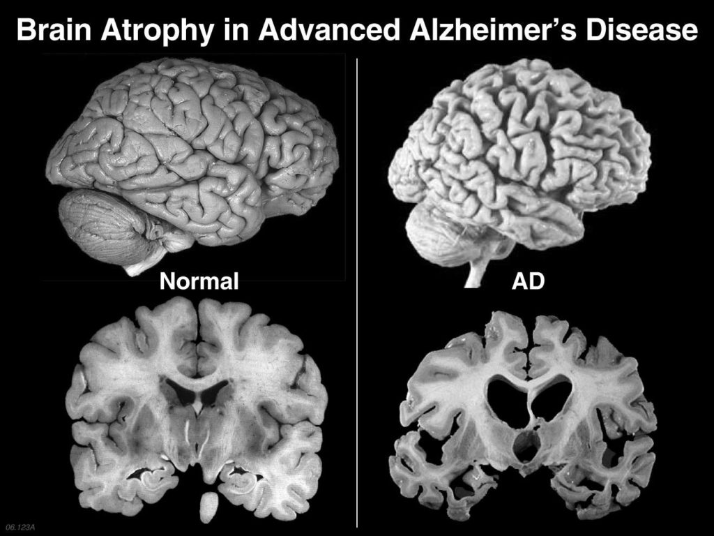 alzheimerss