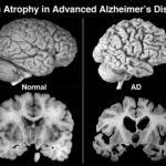 Найдено лекарство, способное победить болезнь Альцгеймера