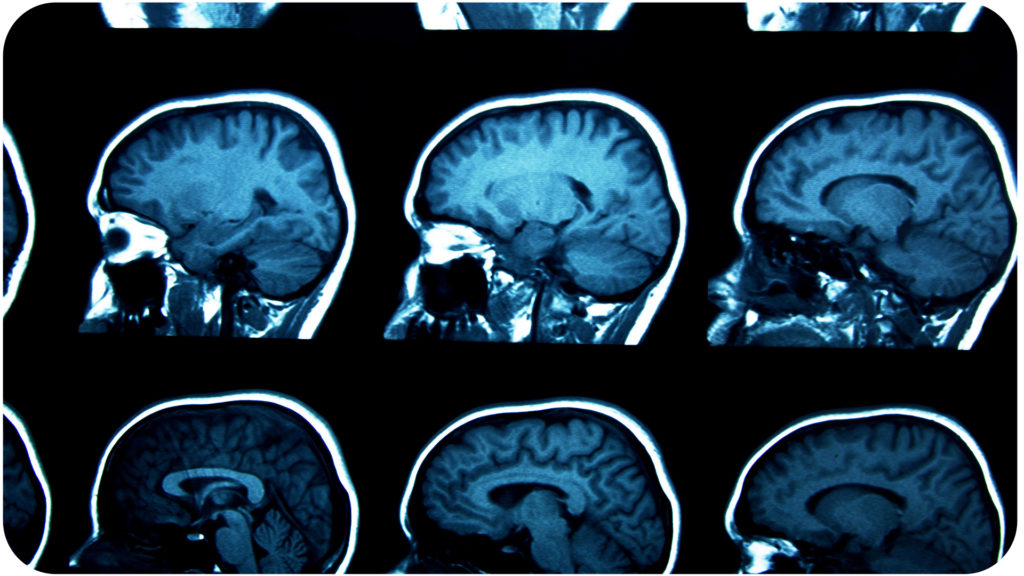 brainepilepsy_full