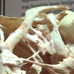 Фибродисплазия — болезнь, которая превращает мышцы в кости