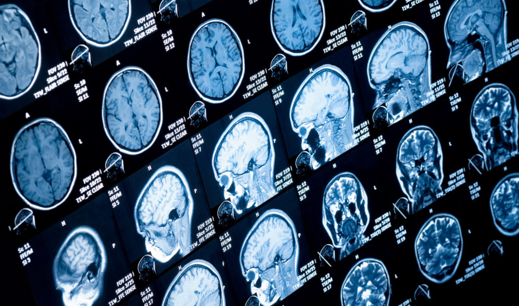 brainscan0