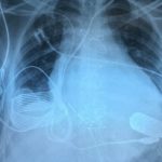 В грудь 24-летнего мужчины впервые внедрили «бионическое сердце» с возможностью беспроводной зарядки