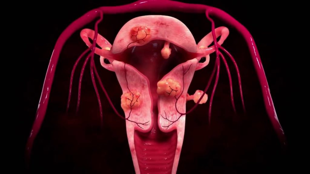 Миома матки: чем лечить – иллюстрация к материалу на Naked Science