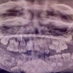Во рту у индийского ребенка обнаружили 526 лишних зубов