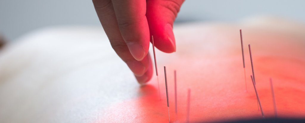012-acupuncture_1024