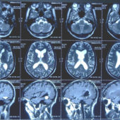 Обнаружены перспективные вещества для борьбы с болезнью Альцгеймера
