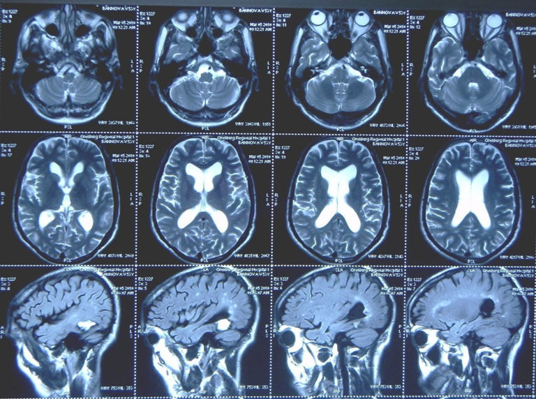 Обнаружены перспективные вещества для борьбы с болезнью Альцгеймера