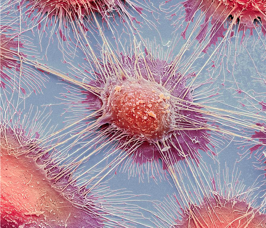 Нагреть и разрушить: ученые тестируют новые типы наночастиц для «прицельной» борьбы с раком