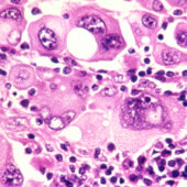 Клетки метастазирующей меланомы человека