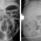 Рентгеновские снимки младенцев с некротическим энтероколитом