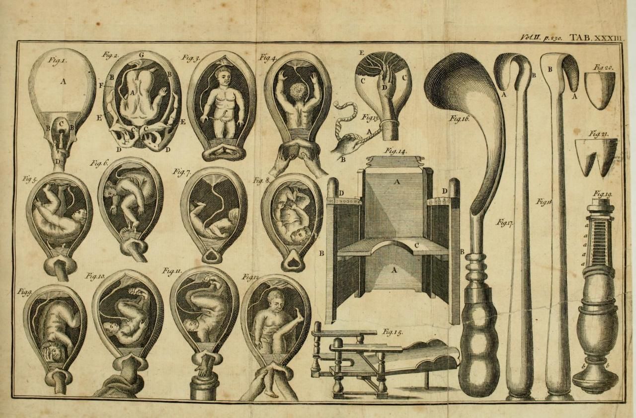 Первые в роду не простое решение. Инструменты Максимович-Амбодик. Акушерские щипцы 18 век.