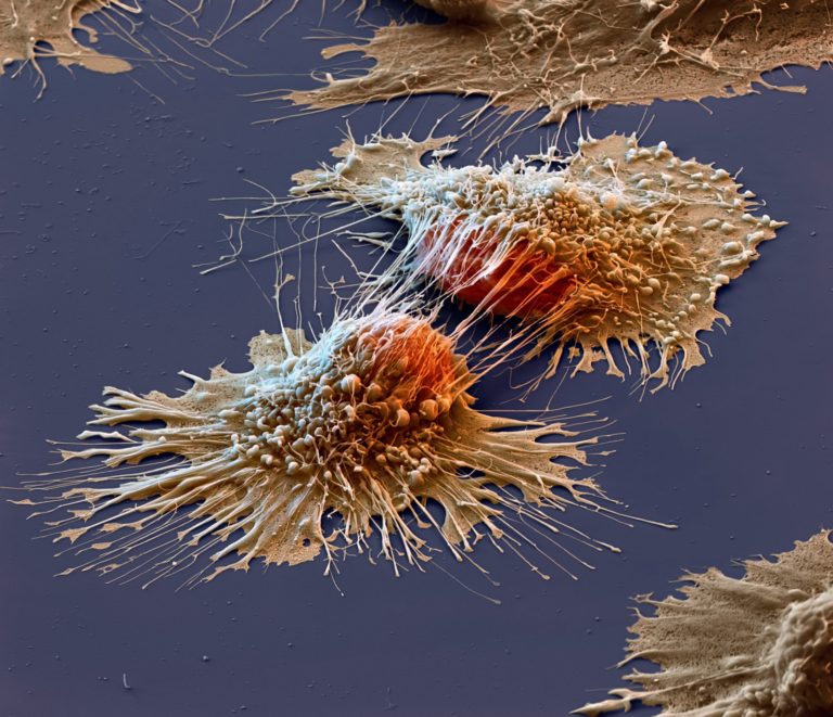 Раковые клетки под электронным микроскопом