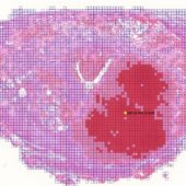 Пример изображения, на котором нейросеть выделяет зону возможной патологии (обозначена темно-красным цветом)