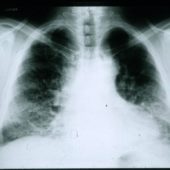 Рентгеновский снимок пациента с фиброзом легких