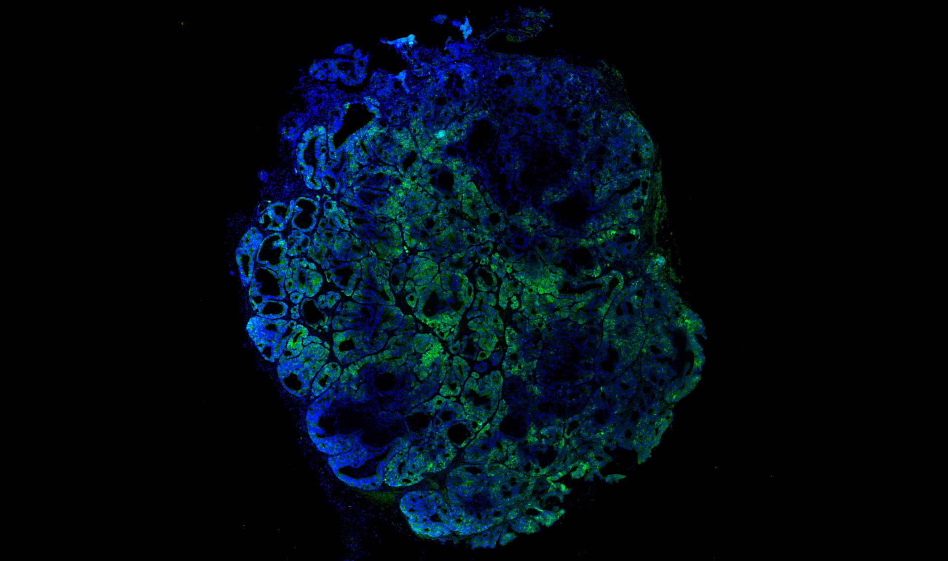 Образец колоректального рака мыши с протеинами, меченными флуоресцентными метками для отслеживания поведения стволовых раковых клеток