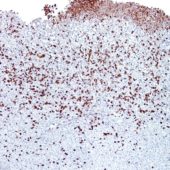 Препарат меланомы кожи, инфильтрованной макрофагами, ассоциированными с опухолью