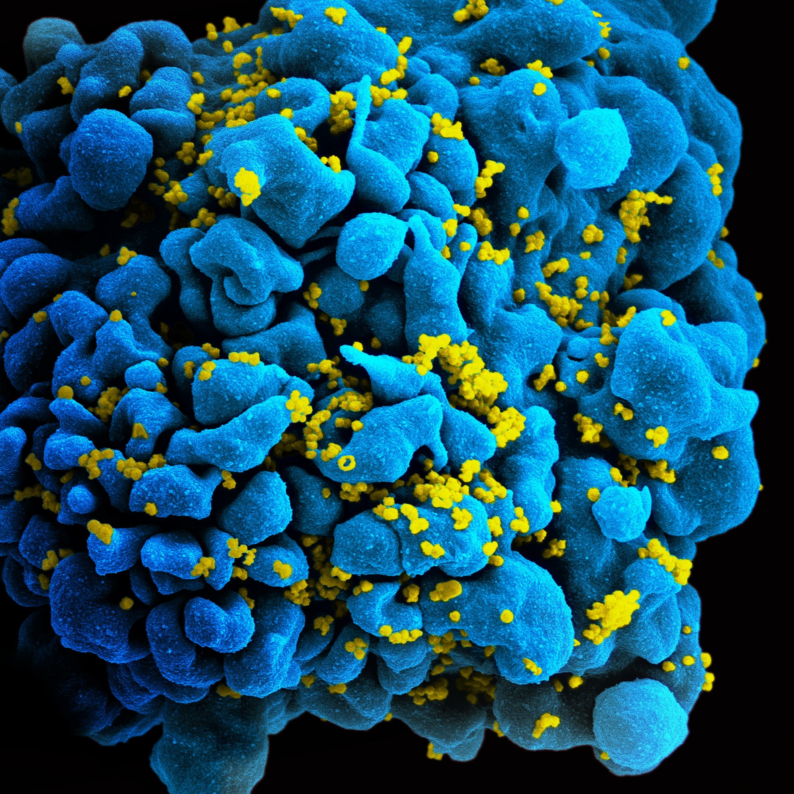 Изображение T-лимфоцита, зараженного ВИЧ, полученное при помощи сканирующей электронной микроскопии