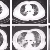 Компьютерная томография легких пациента с коронавирусной инфекцией / © Tencent News