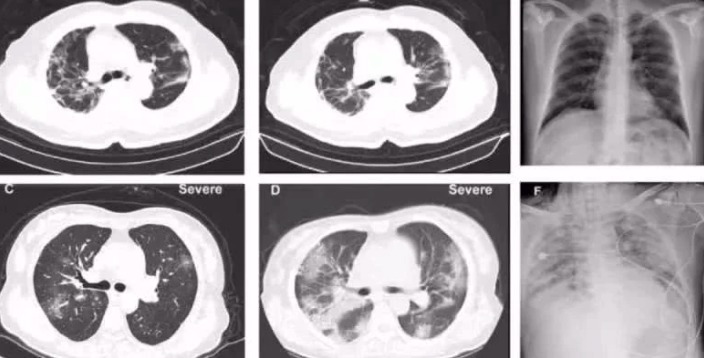 Компьютерная томография легких пациента с коронавирусной инфекцией / © Tencent News