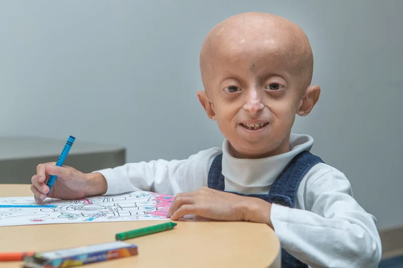 Ребенок с прогерией / © Boston Children’s Hospital