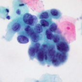 Опухолевые клетки карциномы