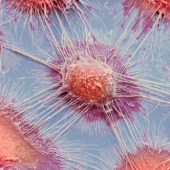 Микрофотография клеток плоскоклеточной карциномы тканей ротовой полости человека