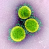 Изображение капсидов вируса SARS-CoV-2, полученные на сканирующем и просвечивающем электронном микроскопе / © NIAID