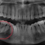 У 37-летнего мужчины вырос чрезвычайно крупный сиалолит, принятый за зуб