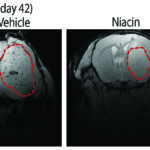 Ниацин оказался полезен при терапии смертельной опухоли мозга