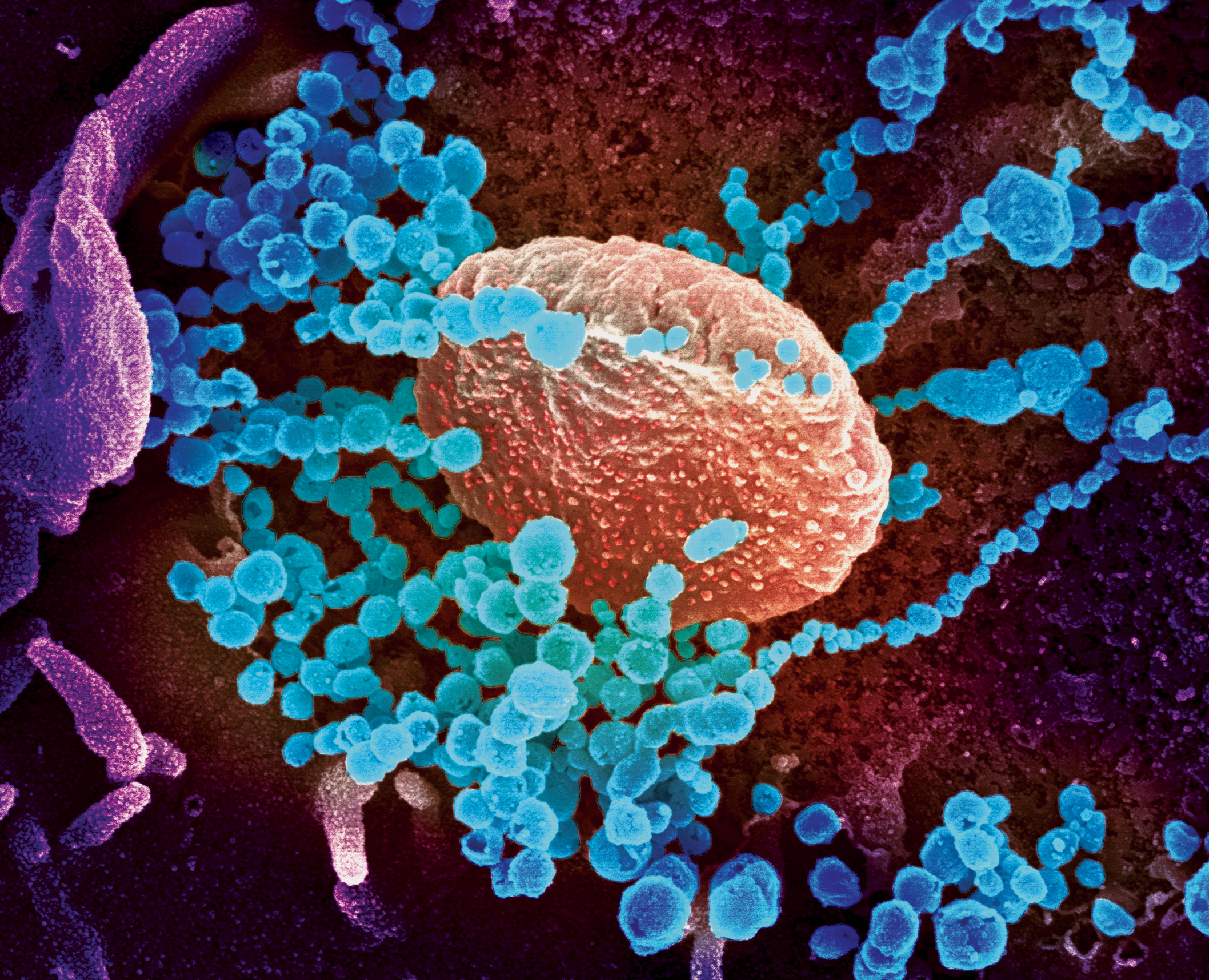 Микрофотография коронавирусных частиц