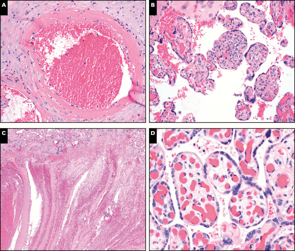 Гистология плаценты при Covid-19. (А) Мелкая артерия с атерозом и фибриноидным некрозом (20-кратное увеличение); (B) Лимфоцитарный виллит (воспаление ворсинок) в 20-кратном увеличении; (С) Линии Зана, типичный признак развития тромбоза (5-кратное увеличение); (D) Хорангиоз (гиперкаплляризация ворсин) плода в 40-кратном увеличении / © Goldstein et al., American Journal of Clinical Pathology, 2020.