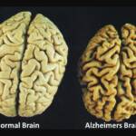 Антиоксиданты могут стать профилактикой болезни Альцгеймера