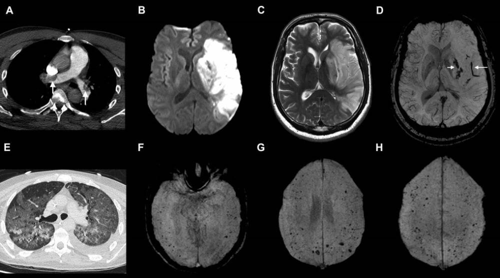МРТ-визуализация мозга двух пациентов, изучавшихся в ходе работы / Paterson, Brown, Zandi et al., Brain, 2020