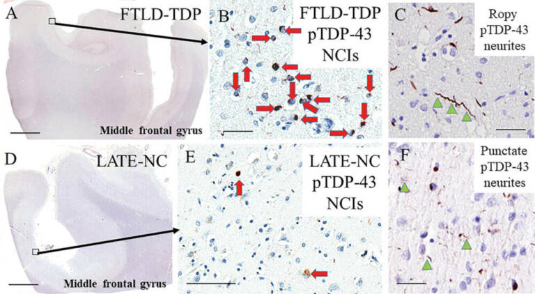 Репрезентативные фотомикрографии, показывающие иммунореактивные особенности TDP-43 в LATE-NC и FTLD-TDP / ©BRAIN: A Journal of Neurology.