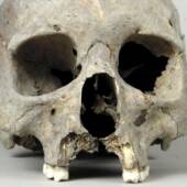 Череп древнего жителя Финляндии сохранил характерные для сифилиса повреждения костей