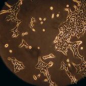 Раковые клетки под микроскопом / ©Институт молекулярной онкологии при Центре исследований рака Мюнхенского университета